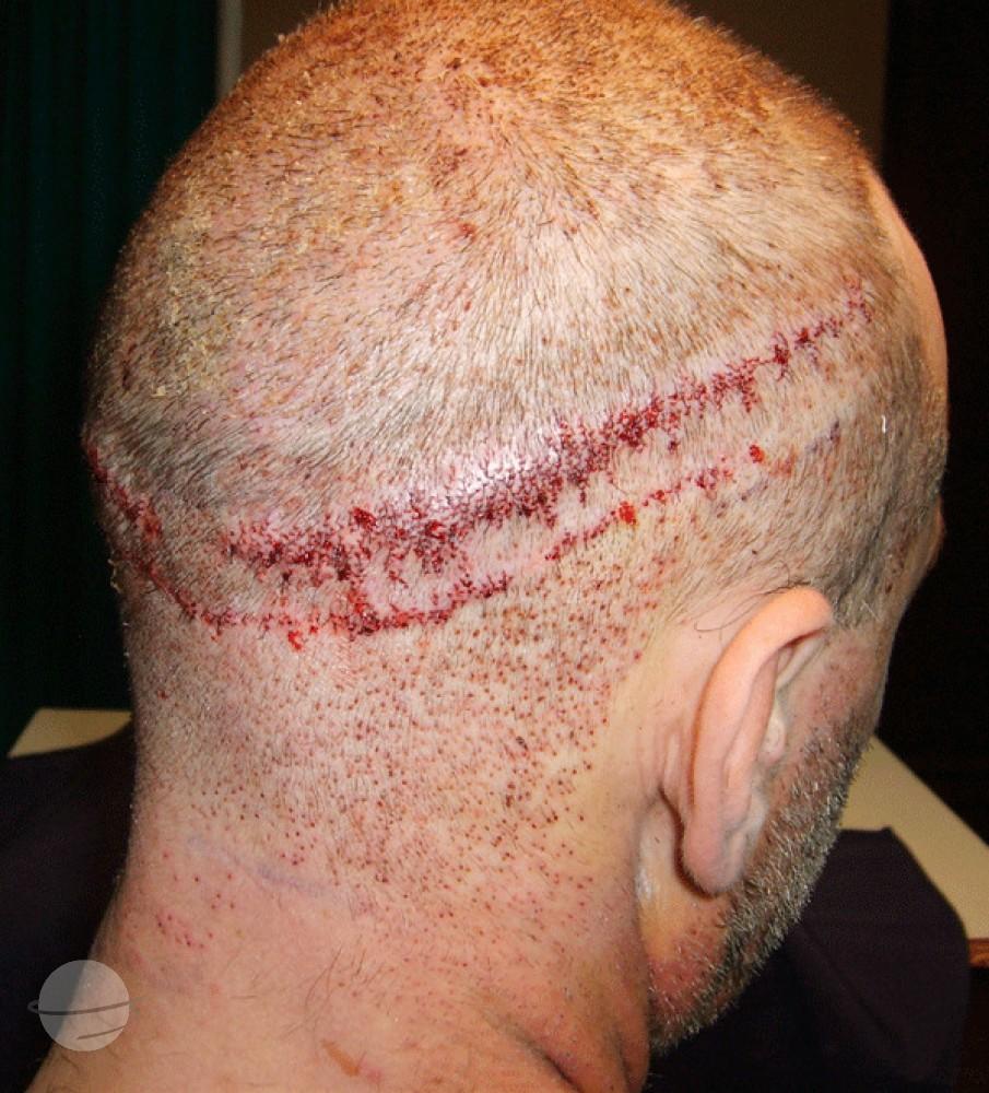 Before and after result for BHT Body Hair Transplant — Dr A's clinic - hair Transplant clinic