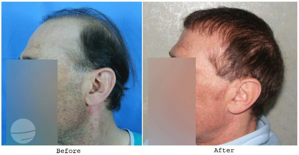 Résultat avant / après pour BHT Body Hair Transplant — Dr A's clinic - Clinique du Dr Poswal