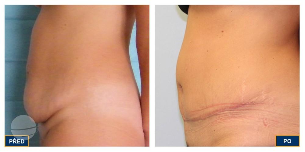 Resultado de antes y después para Abdominoplastia — Premier Clinic