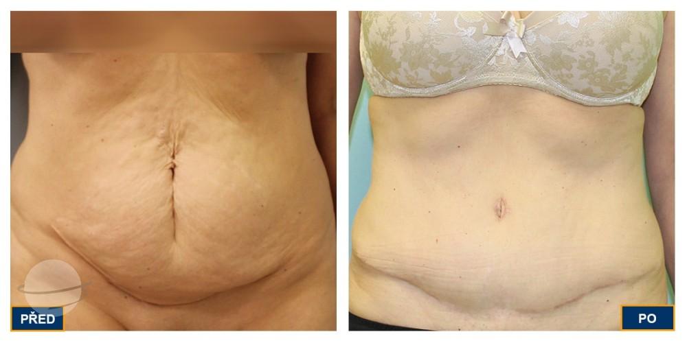 Before and after result for Tummy tuck — Premier Clinic