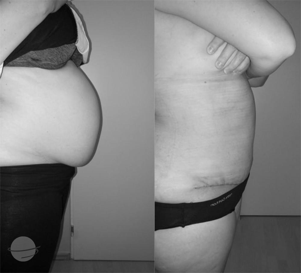 Resultado de antes y después para Abdominoplastia — Premier Clinic