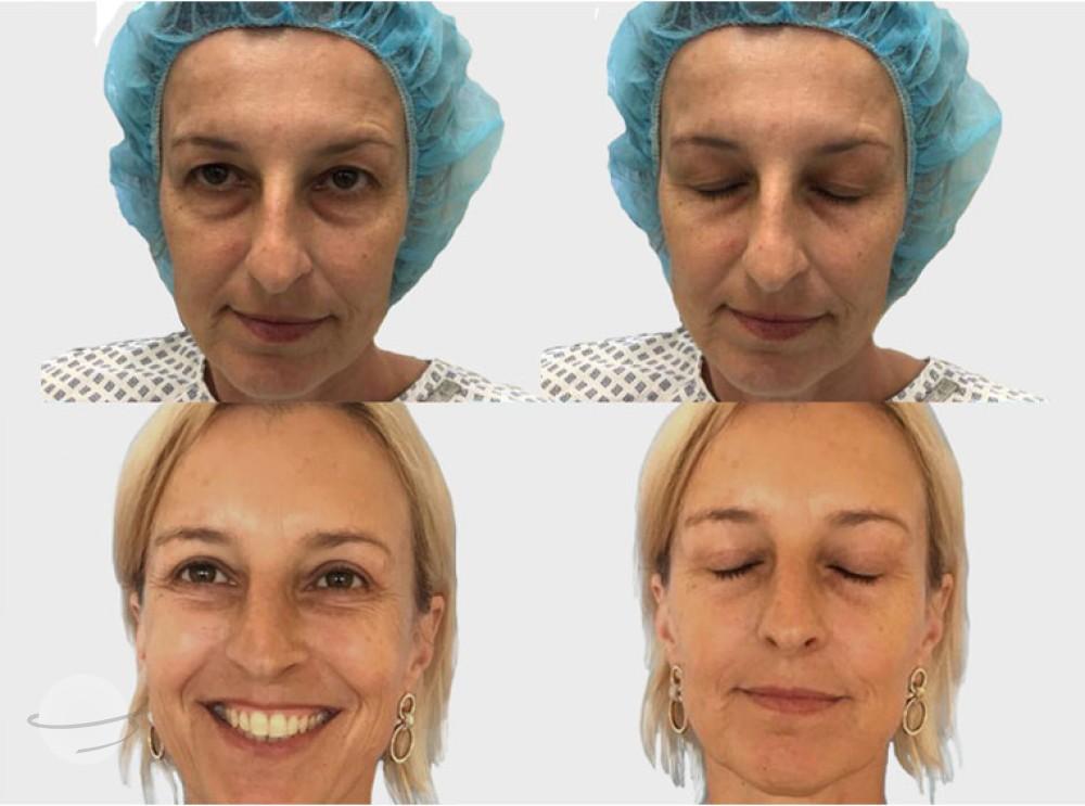 Risultato prima e dopo per Blefaroplastica — Premier Clinic