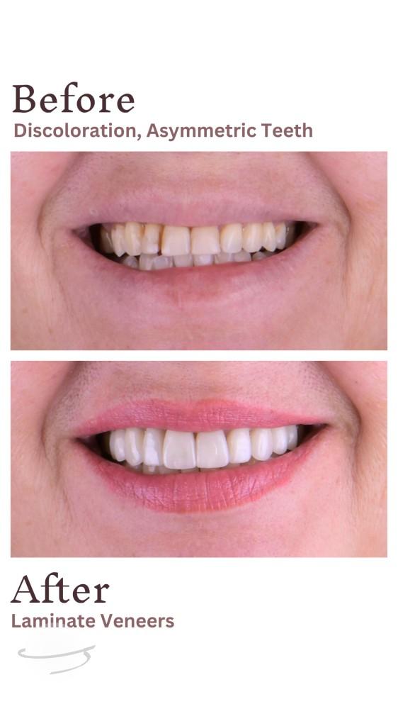 S.G Veneers