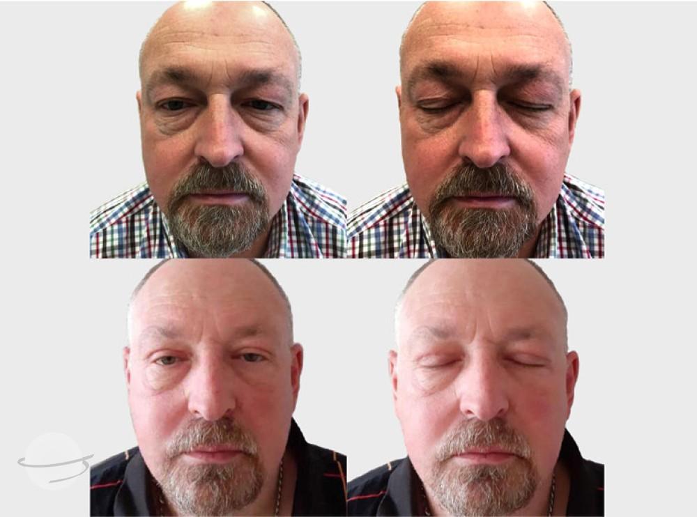 Risultato prima e dopo per Blefaroplastica — Premier Clinic