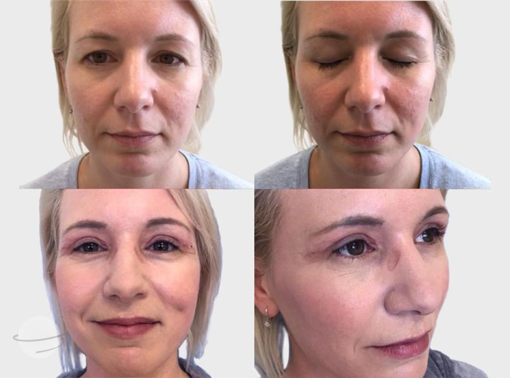 Risultato prima e dopo per Blefaroplastica — Premier Clinic
