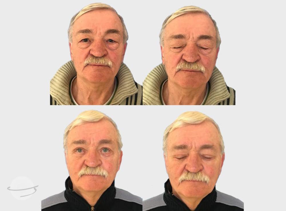 Risultato prima e dopo per Blefaroplastica — Premier Clinic