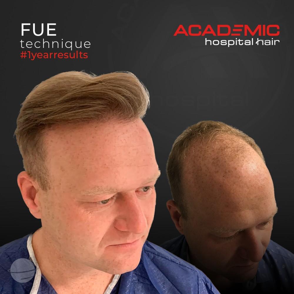 Before and after result for FUE — Academic Esthetics