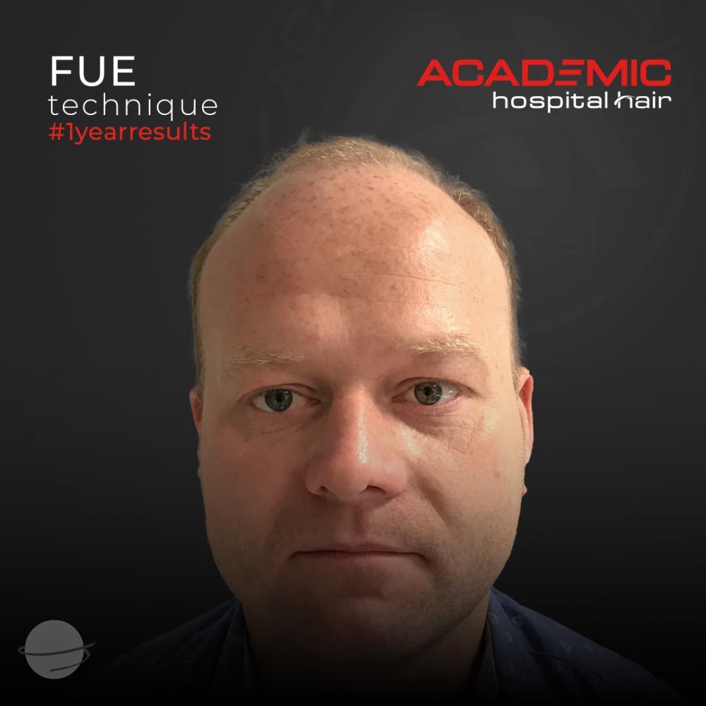 Resultado de antes y después para FUE — Academic Esthetics