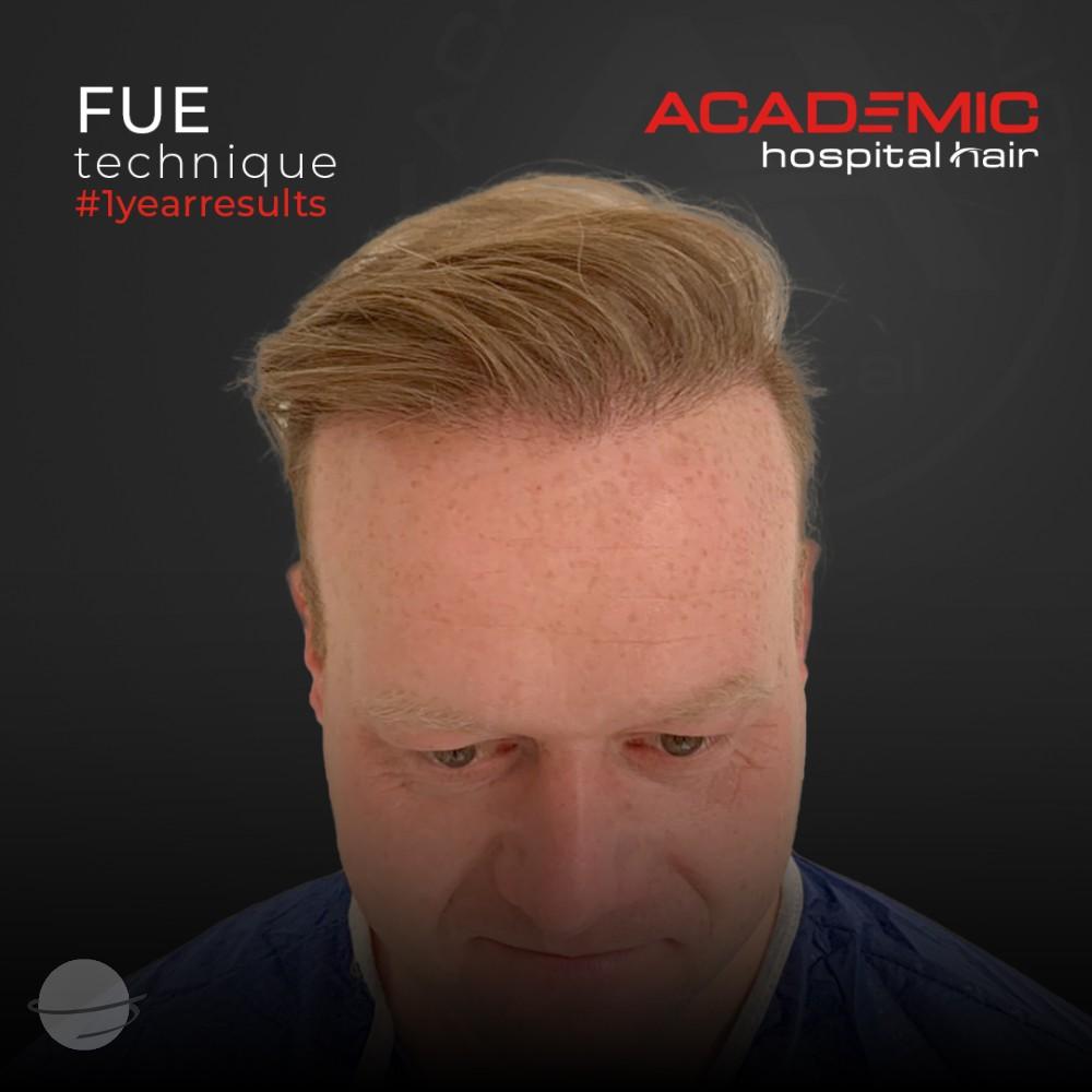 Risultato prima e dopo per FUE — Academic Esthetics