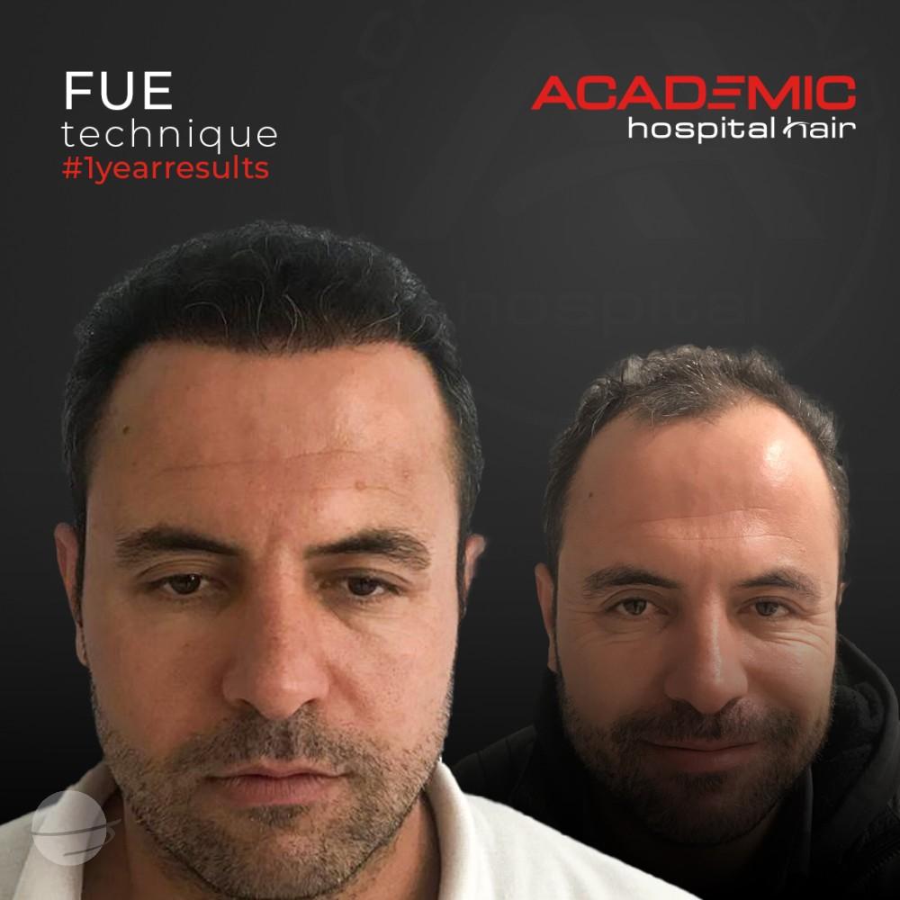 Before and after result for FUE — Academic Esthetics