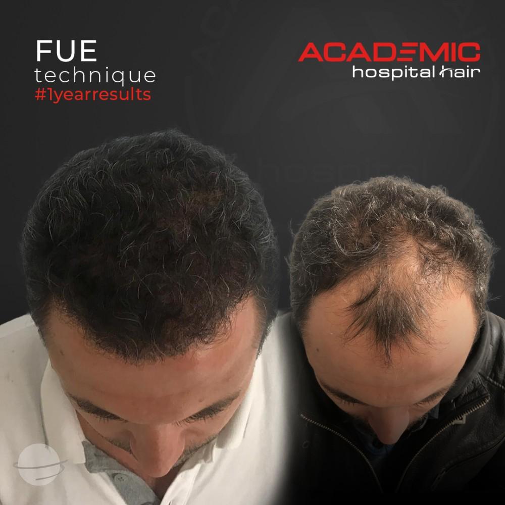 Before and after result for FUE — Academic Esthetics
