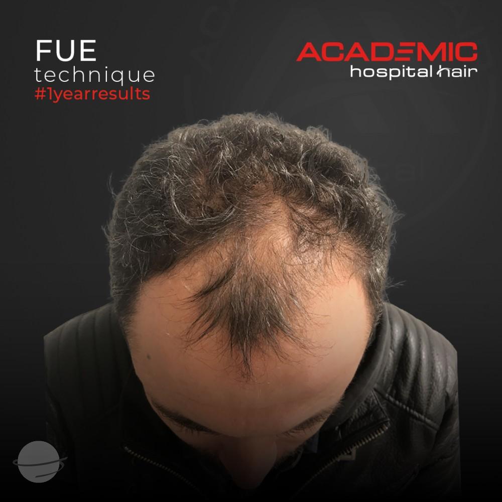 Before and after result for FUE — Academic Esthetics