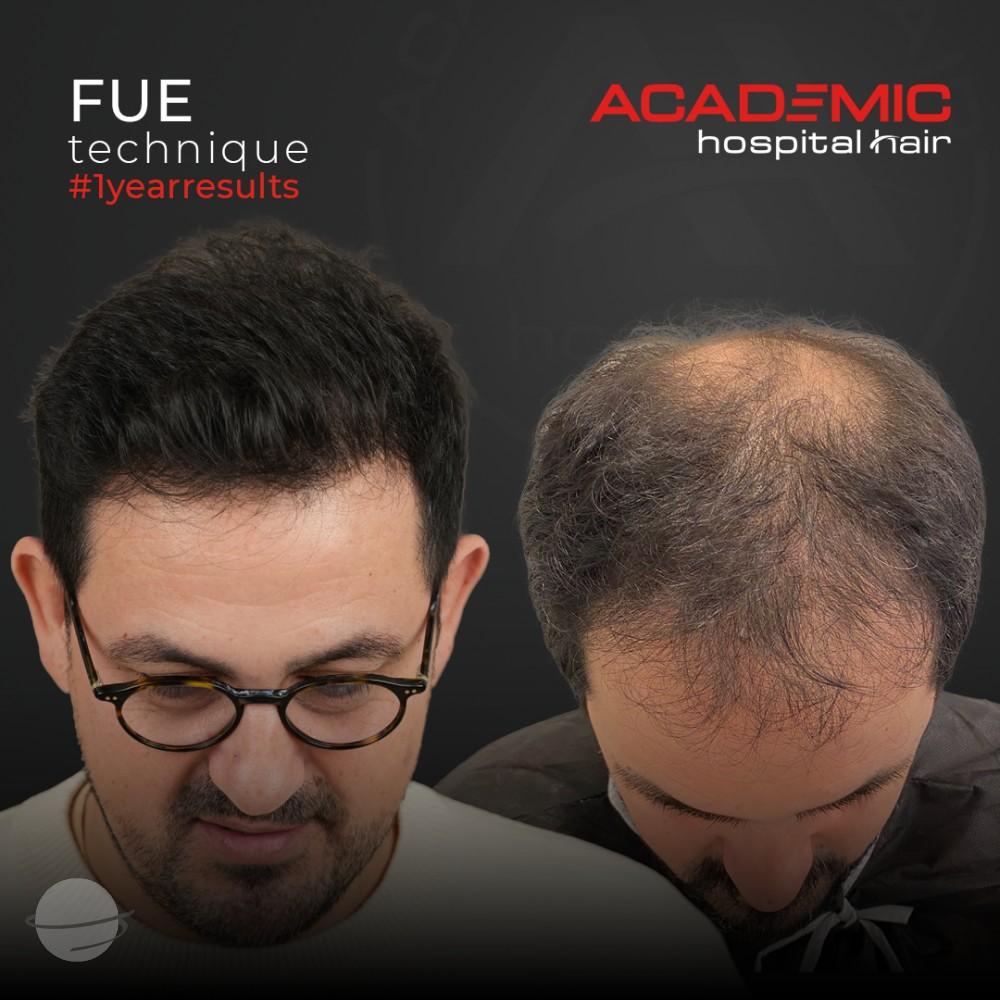 Before and after result for FUE — Academic Esthetics