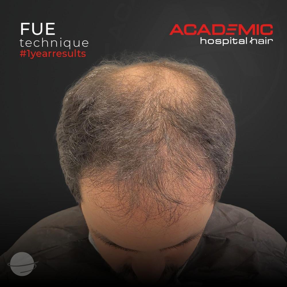 Before and after result for FUE — Academic Esthetics