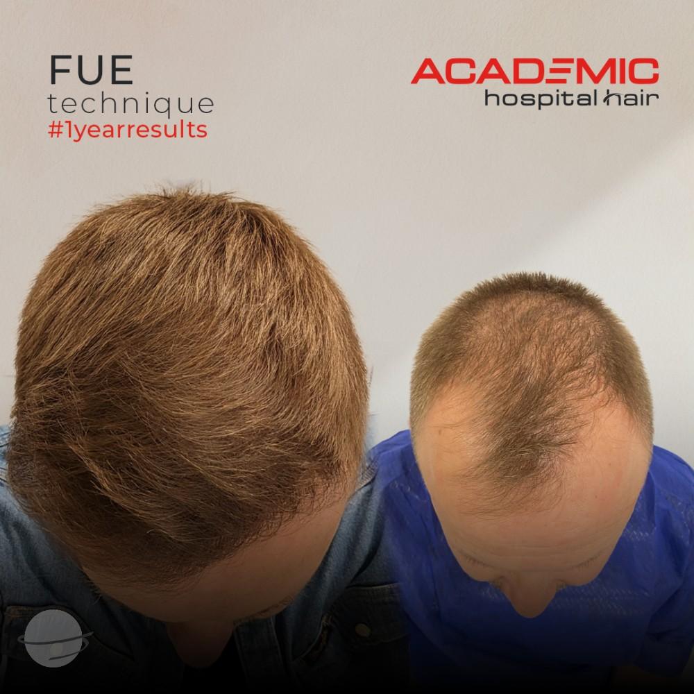 Resultado de antes y después para FUE — Academic Esthetics