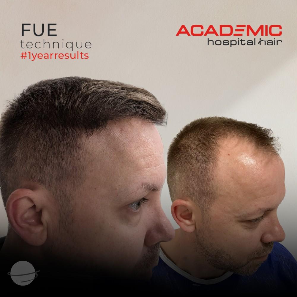 Resultado de antes y después para FUE — Academic Esthetics