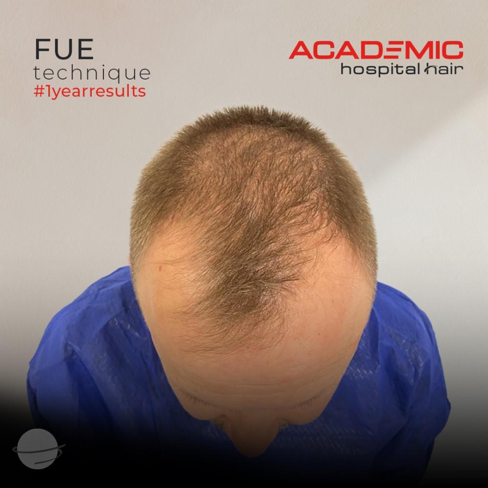 Resultado de antes y después para FUE — Academic Esthetics