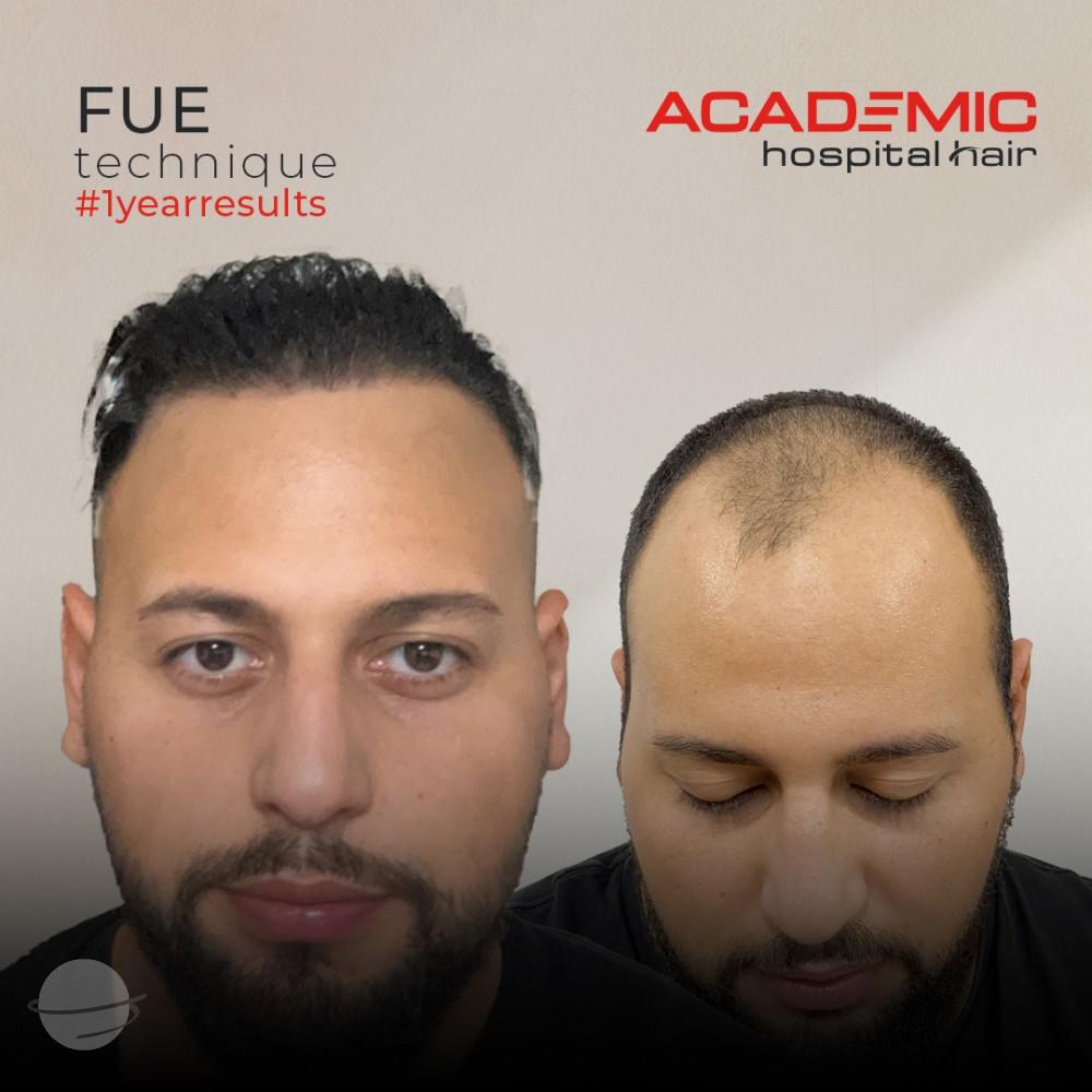 Resultado de antes y después para FUE — Academic Esthetics