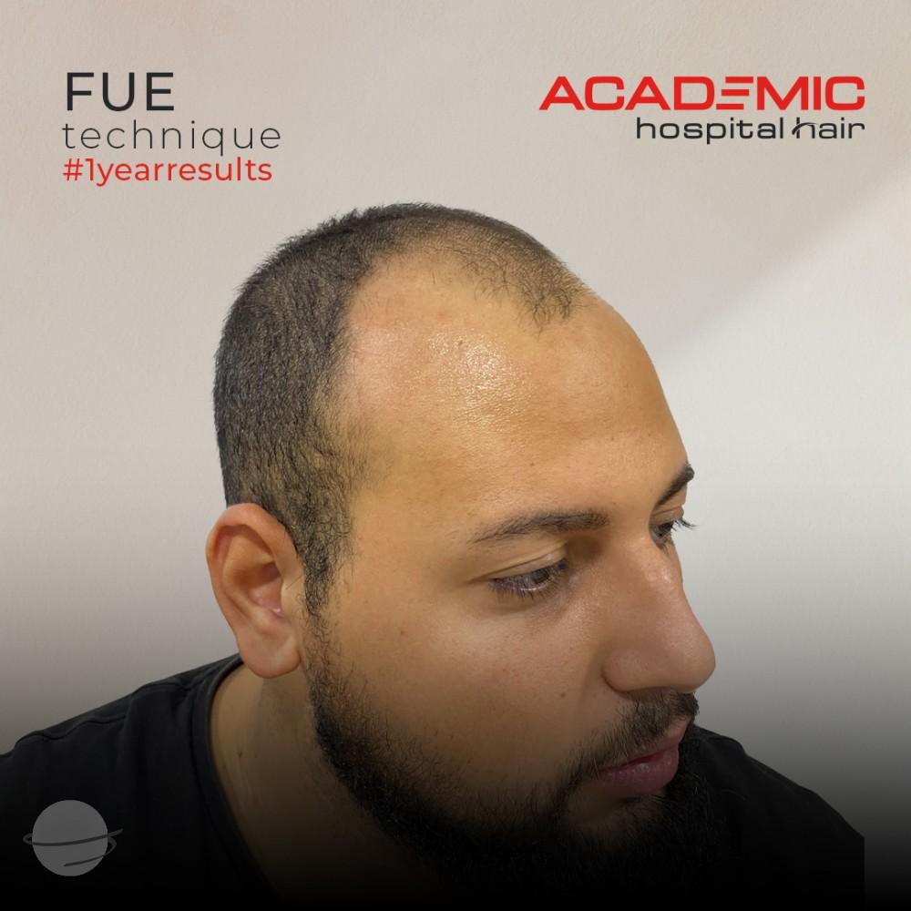 Resultado de antes y después para FUE — Academic Esthetics
