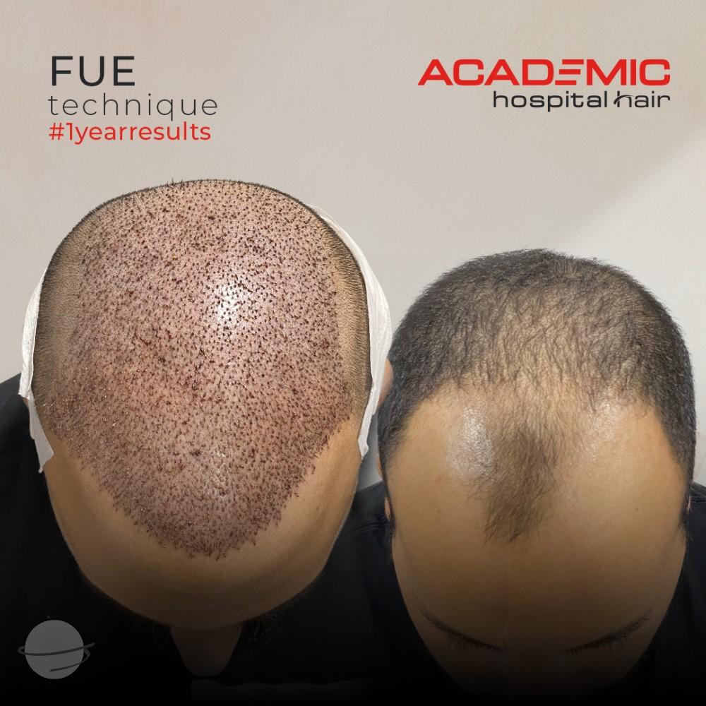 Resultado de antes y después para FUE — Academic Esthetics