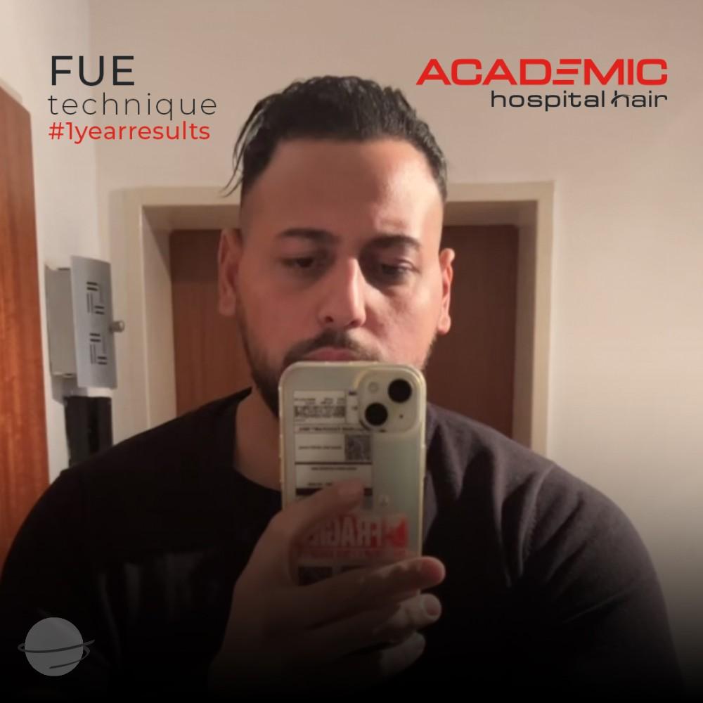 Resultado de antes y después para FUE — Academic Esthetics