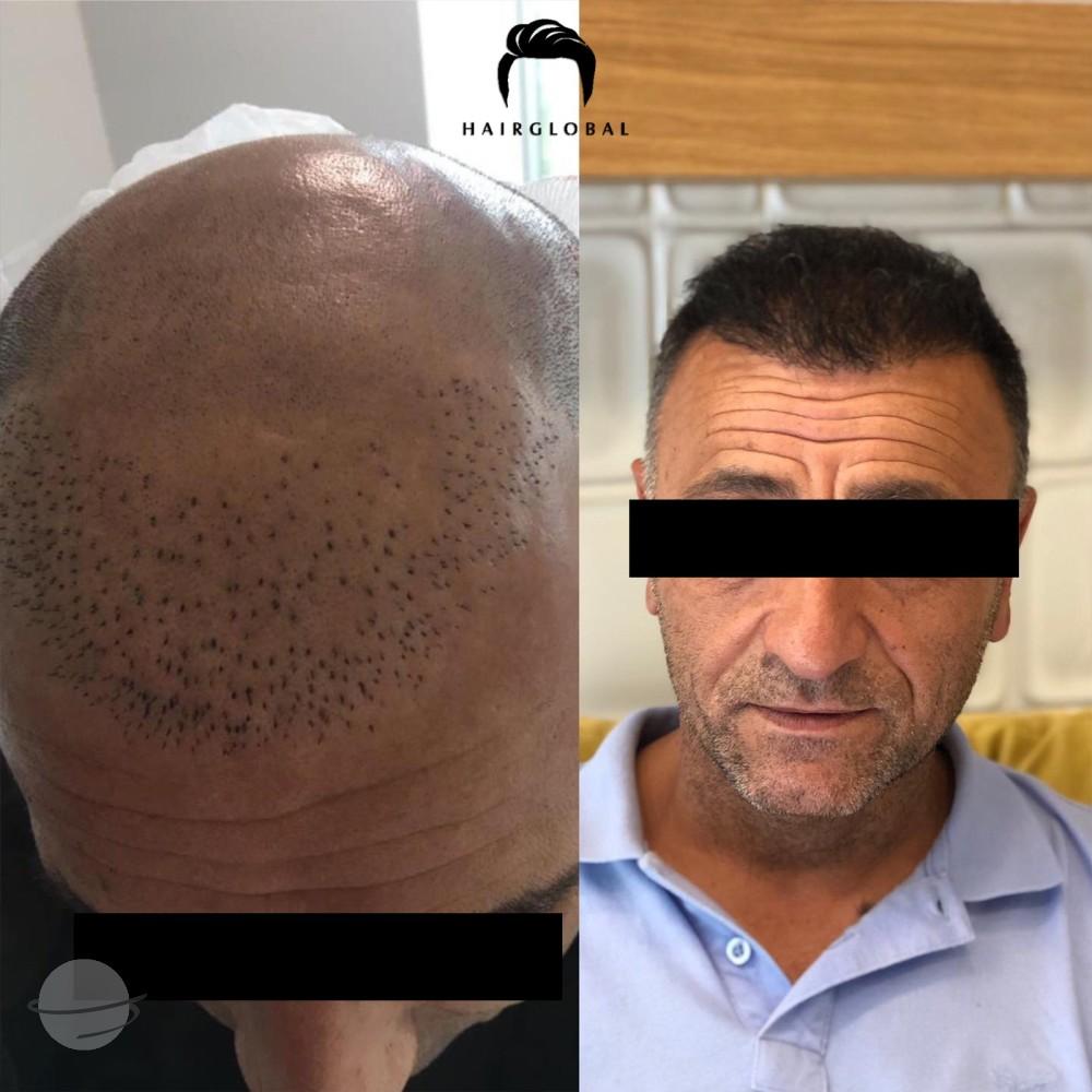 Resultado de antes y después para FUE — HairGlobal