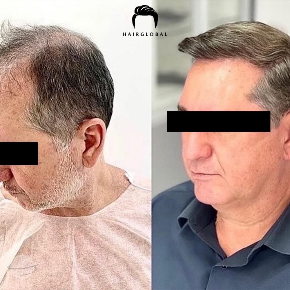 Resultado de antes y después para FUE — HairGlobal