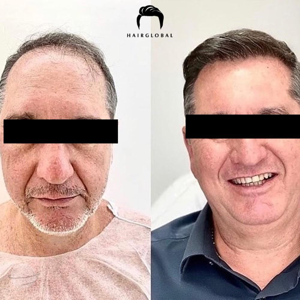 Before and after result for FUE — HairGlobal