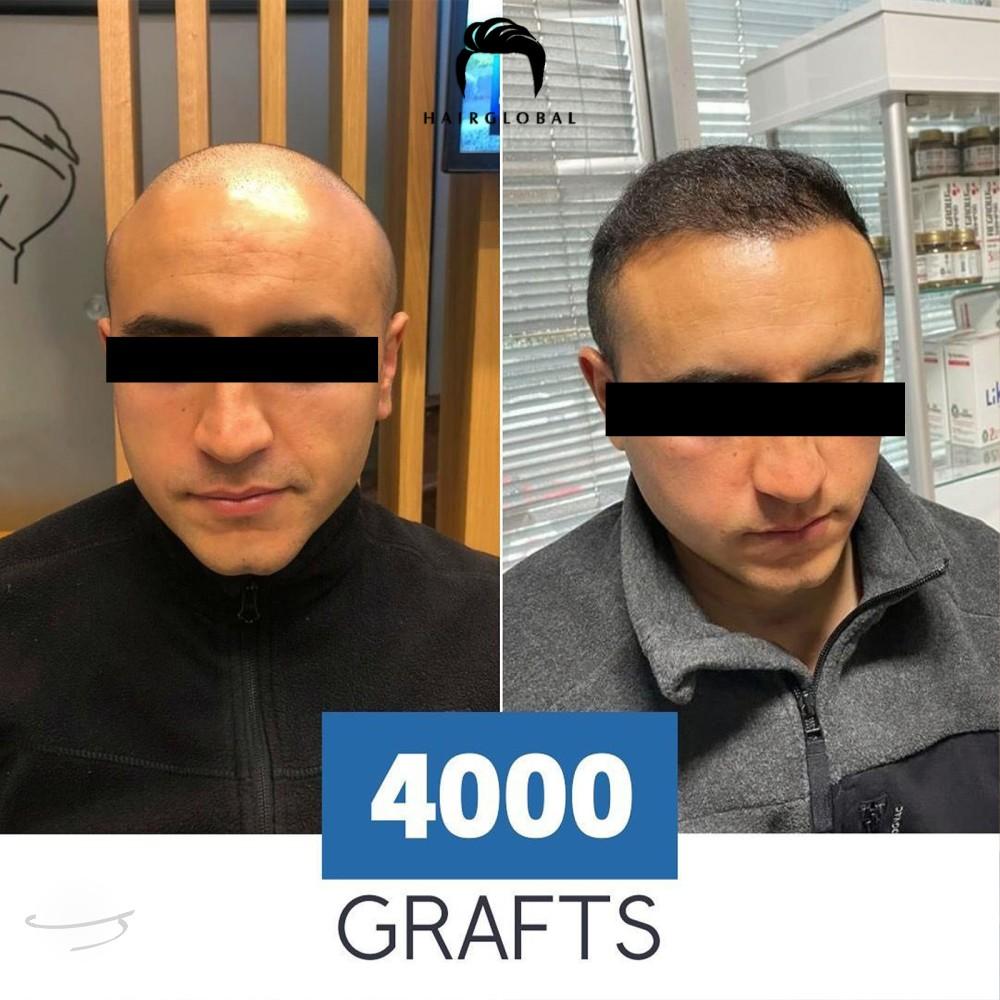 Risultato prima e dopo per FUE — HairGlobal