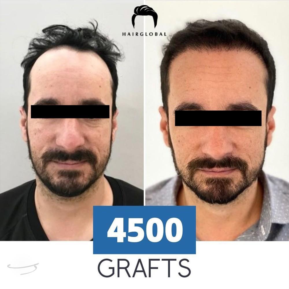 Before and after result for FUE — HairGlobal
