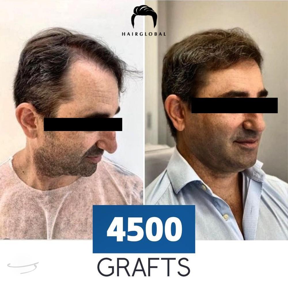 Before and after result for FUE — HairGlobal