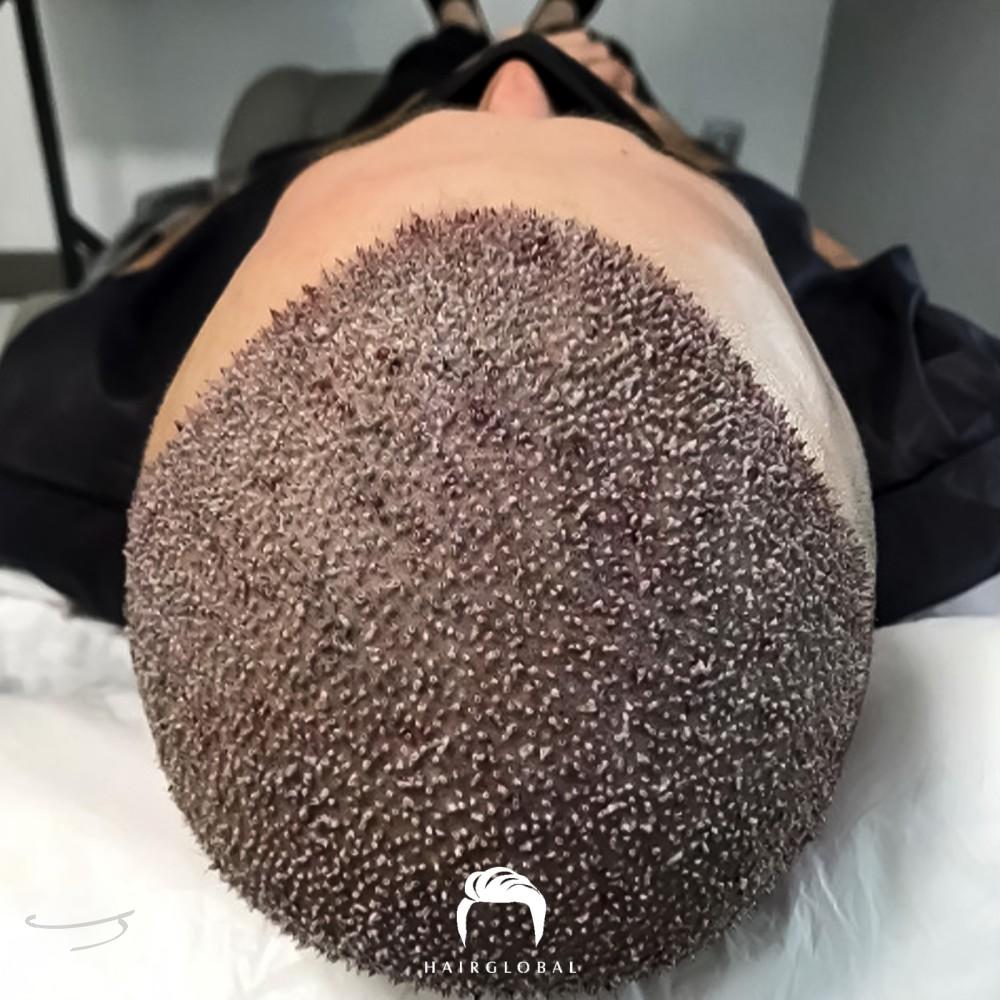 Resultado de antes y después para FUE — HairGlobal