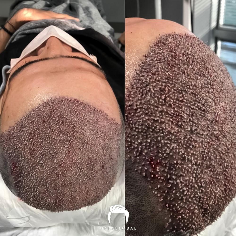 Risultato prima e dopo per FUE — HairGlobal