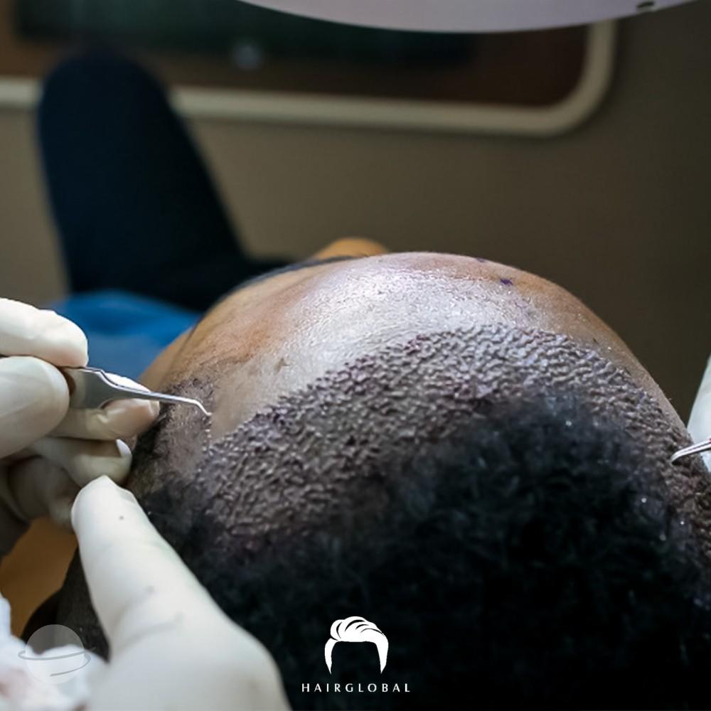 Resultado de antes y después para FUE — HairGlobal