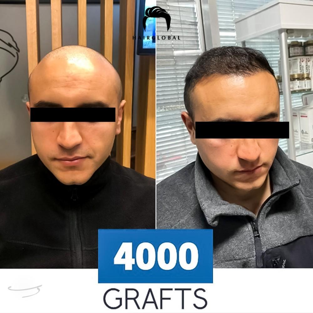Resultado de antes y después para FUE — HairGlobal