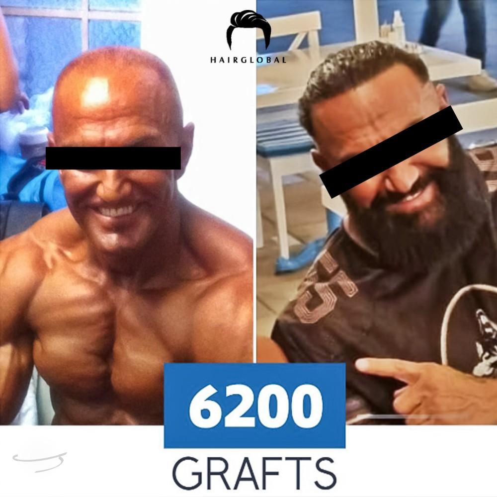 Resultado de antes y después para FUE — HairGlobal