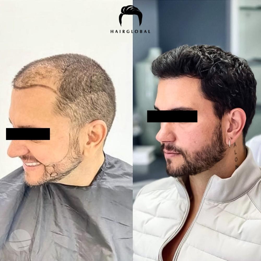 Résultat avant / après pour FUE — HairGlobal