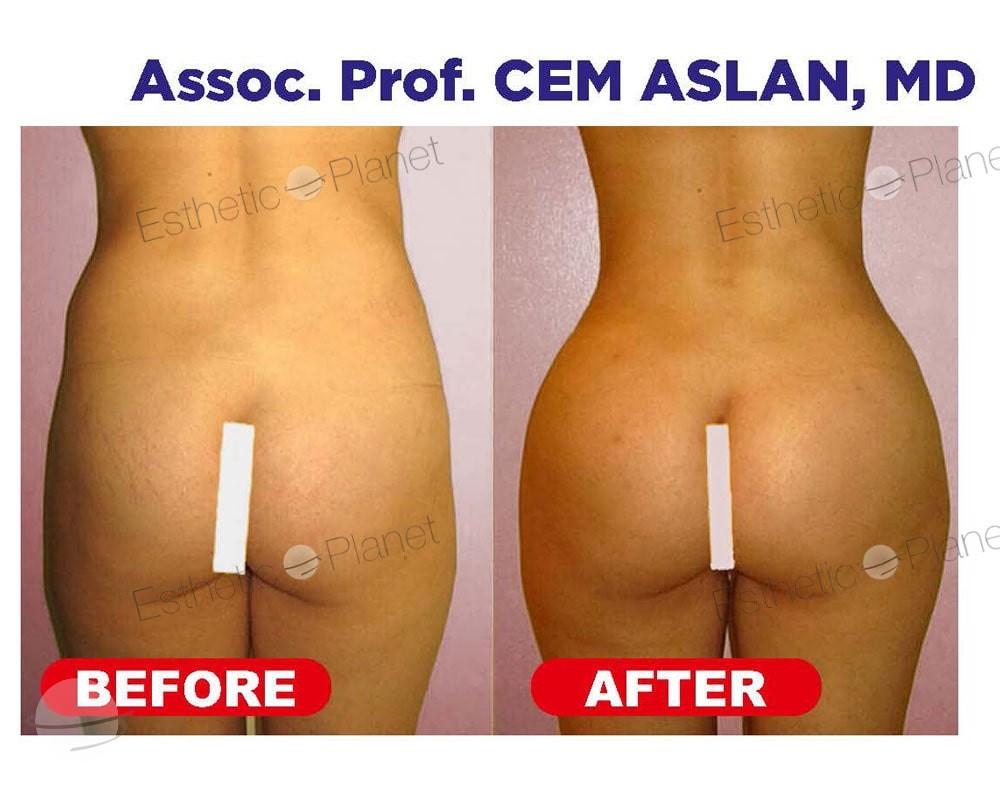 Résultat avant / après pour BBL Lipofilling fessier — Ekol Hastanesi
