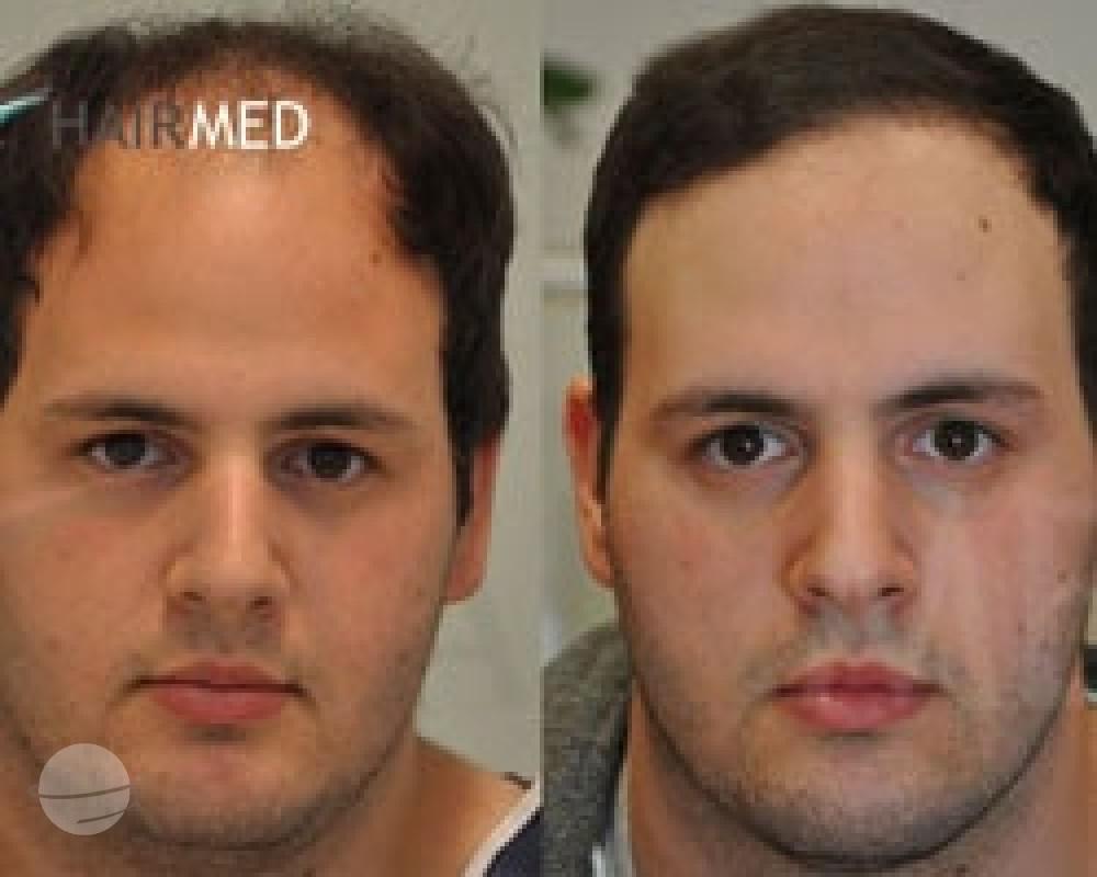 Résultat avant / après pour FUE — Dr. Sikos Geza Clinic