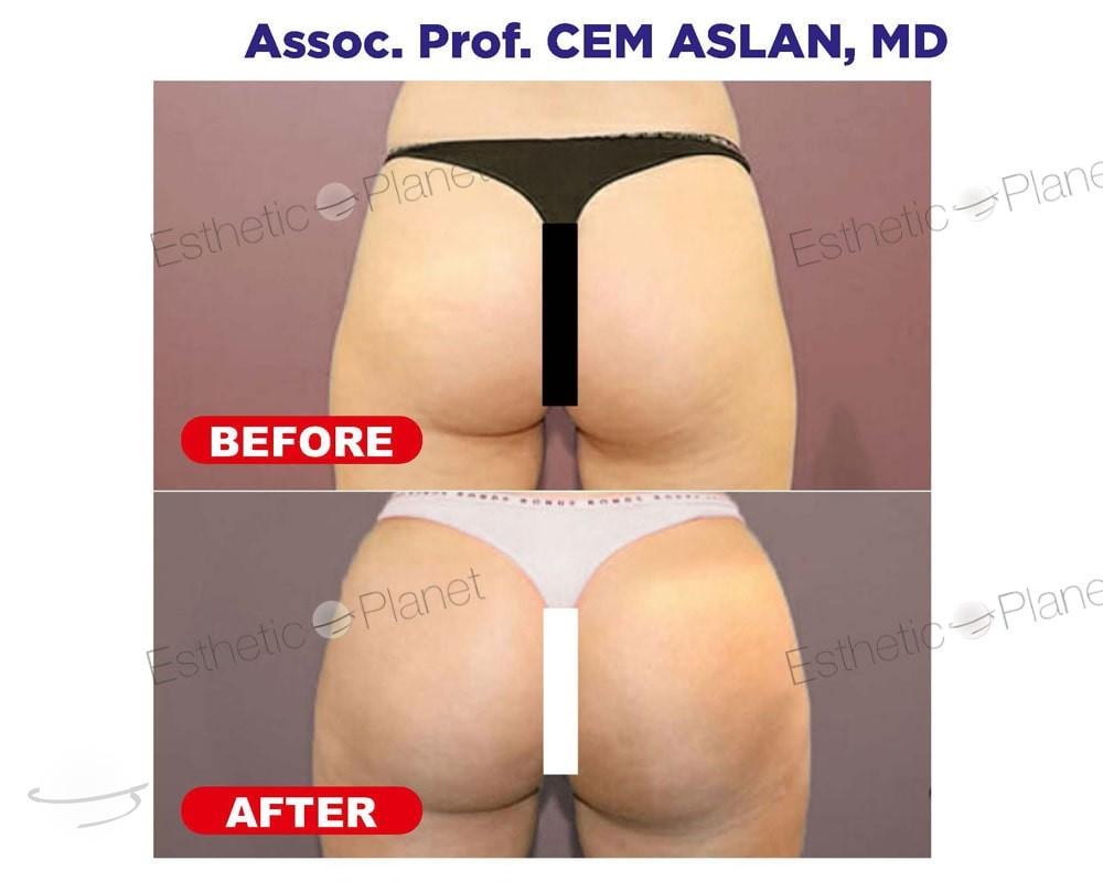 Résultat avant / après pour BBL Lipofilling fessier — Ekol Hastanesi
