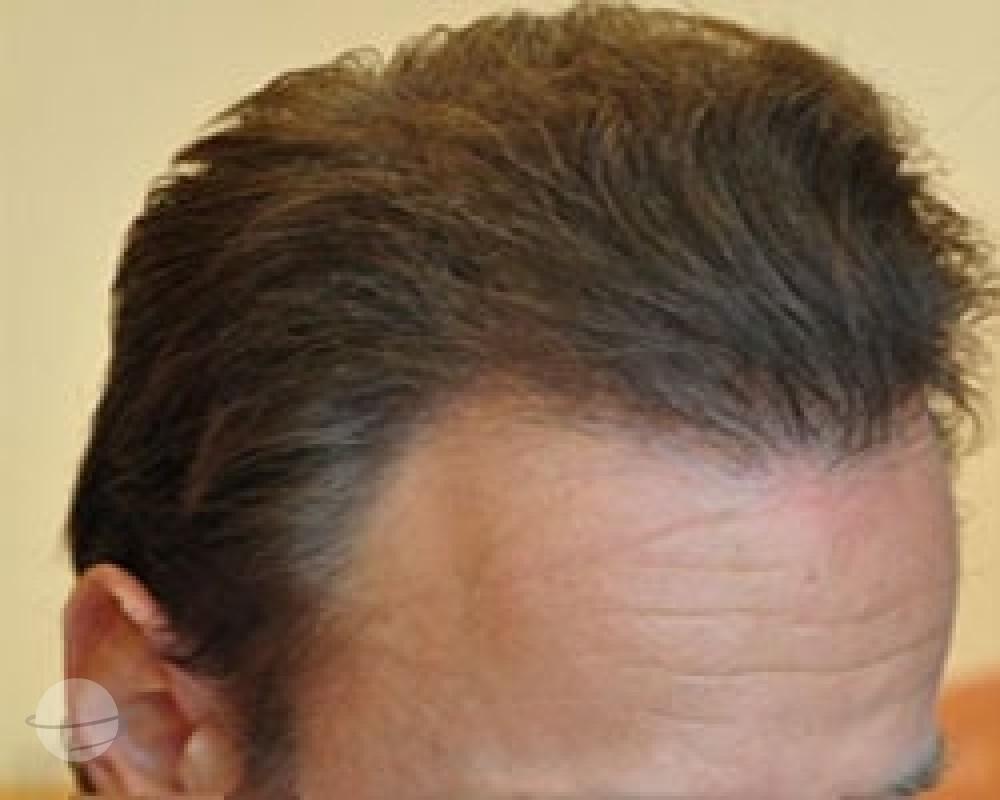 Résultat avant / après pour FUE — Dr. Sikos Geza Clinic