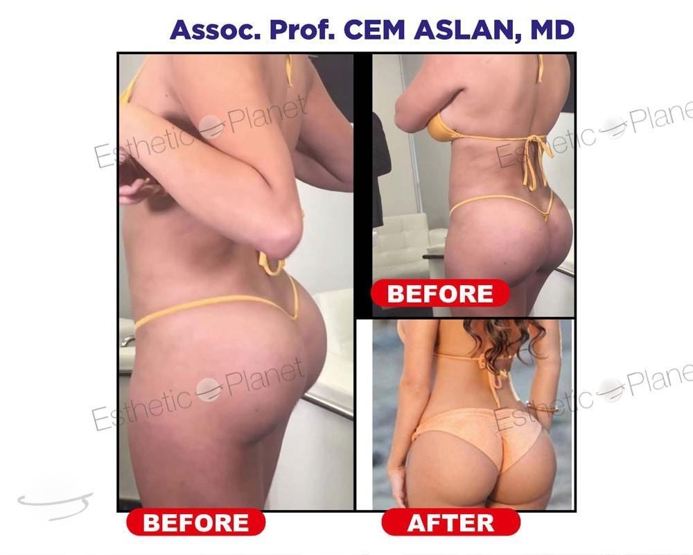 Résultat avant / après pour BBL Lipofilling fessier — Ekol Hastanesi