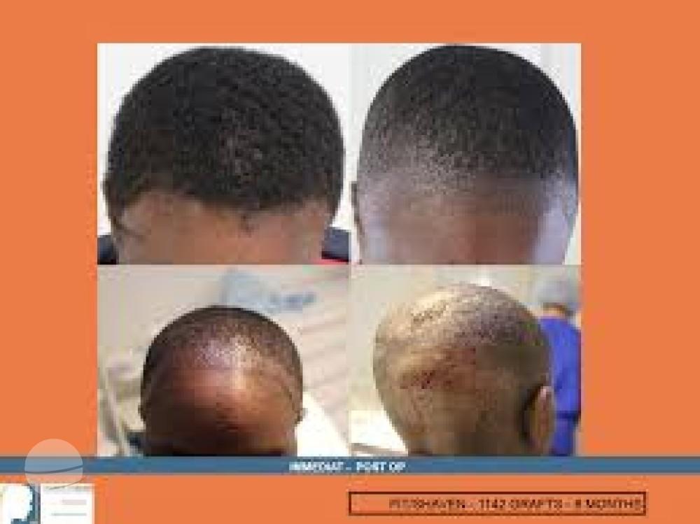 Dr Patrick Mwamba Hair transplant result 