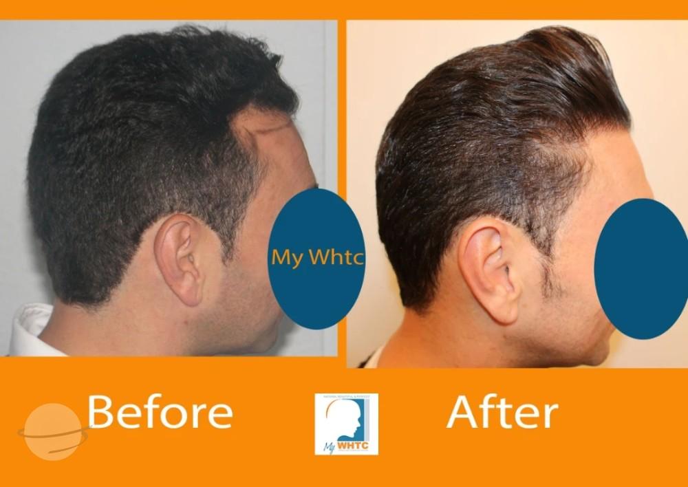 Dr Patrick Mwamba Hair transplant result 