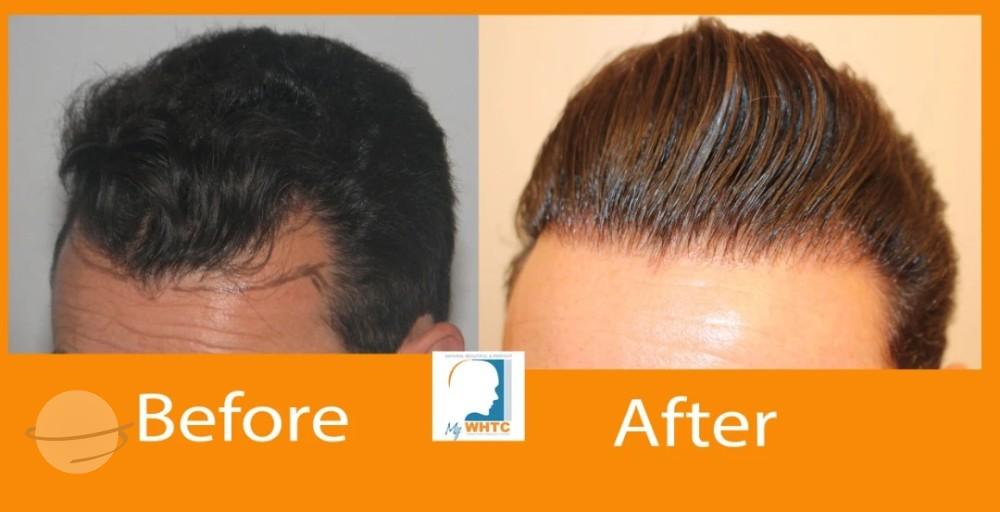 Dr Patrick Mwamba Hair transplant result 