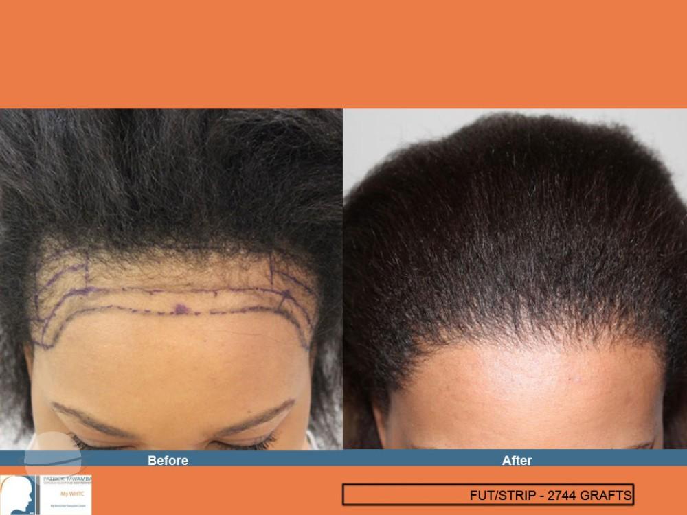 Dr Patrick Mwamba Hair transplant result 