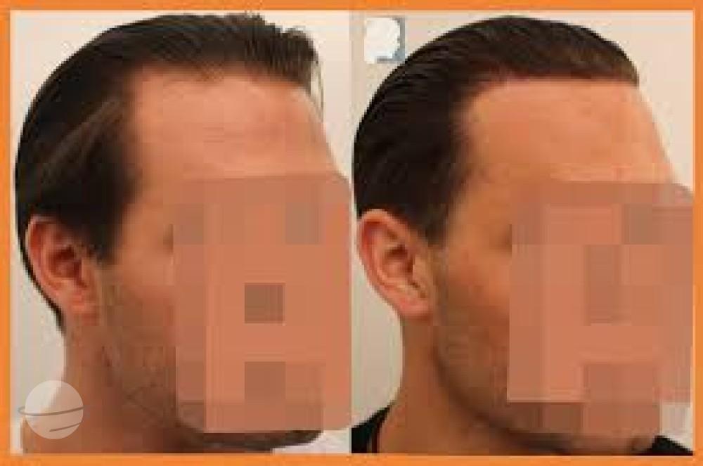 Dr Patrick Mwamba Hair transplant result 