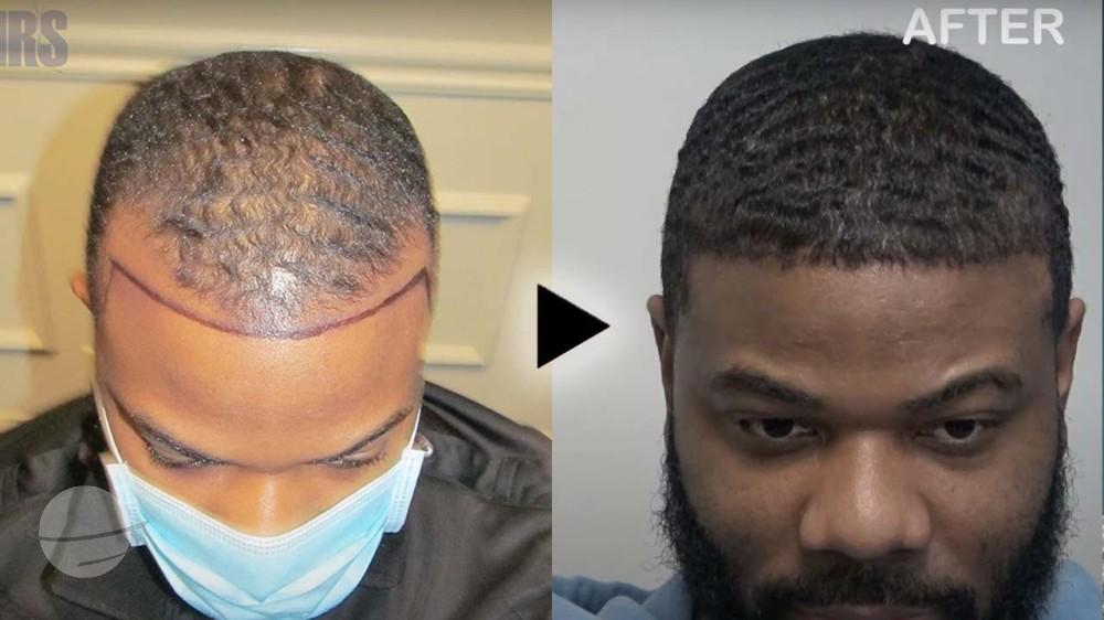 Dr Patrick Mwamba Hair transplant result 