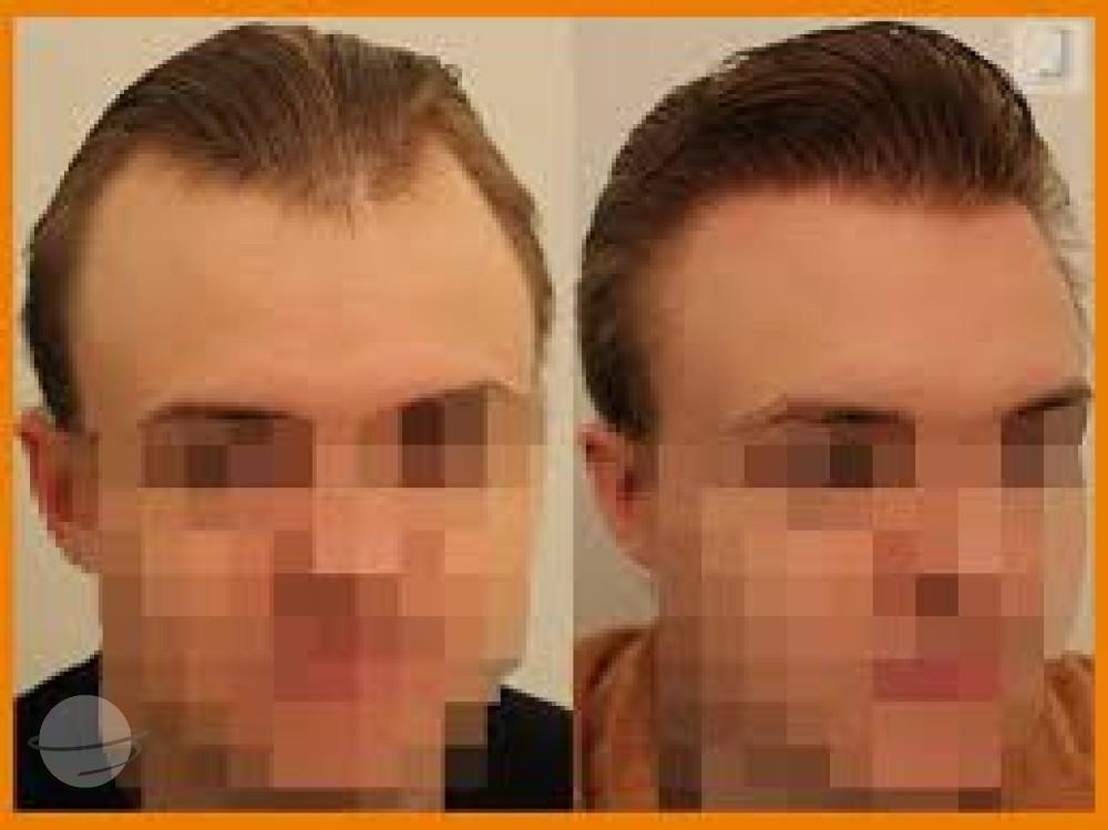 Dr Patrick Mwamba Hair transplant result 