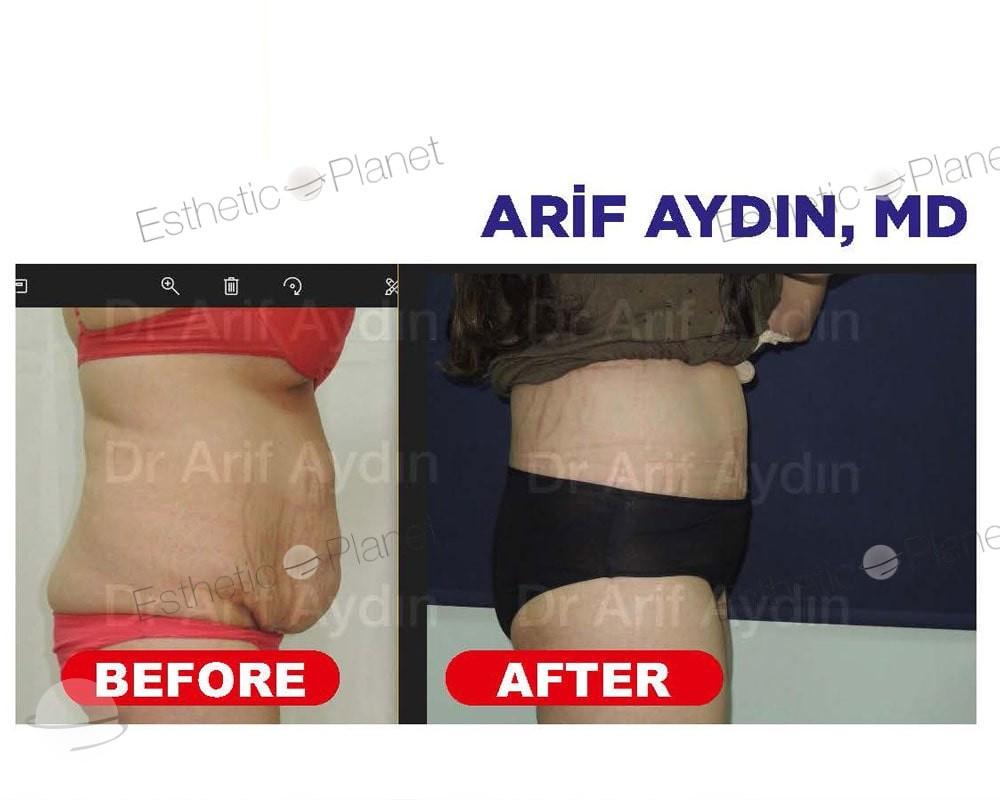 Résultat avant / après pour Abdominoplastie — Ekol Hastanesi